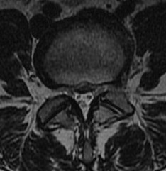 Lumbar Central Disc Herniation MRI